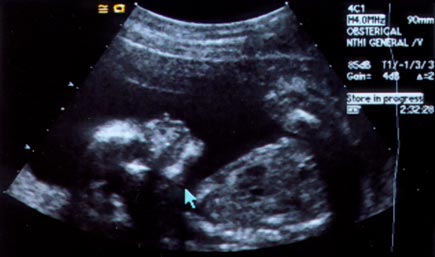 buttonette's ultrasound